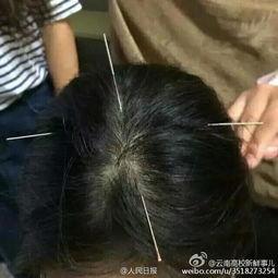 扎针可以吃瓜吗,扎针后能吃瓜？揭秘扎针与饮食的奇妙关系